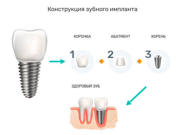 Классическая имплантация